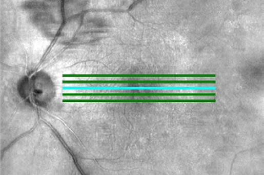 Makuladegeneration - Dr. med. Alina Goth - Augenarzt in Sonthofen